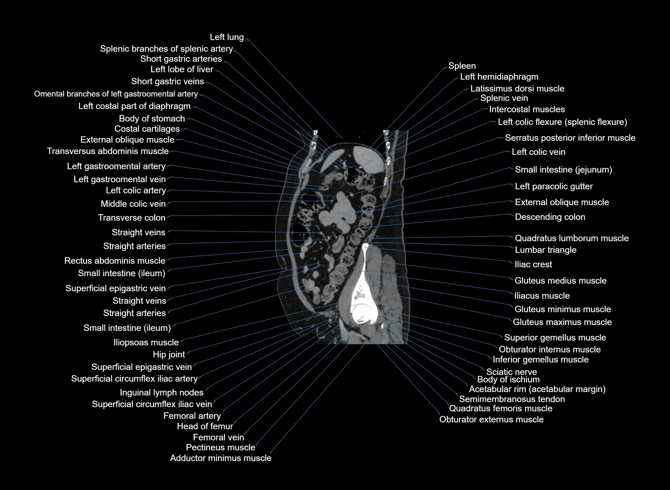CT Abdomen sagittal cross sectional anatomy labelled radiology image -00030.webp